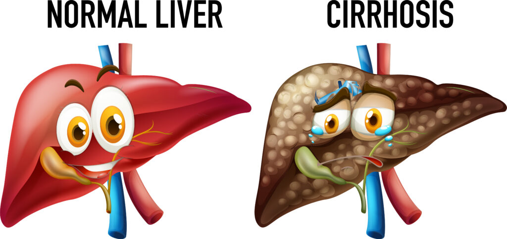 Illustration du foie normal et de la cirrhose